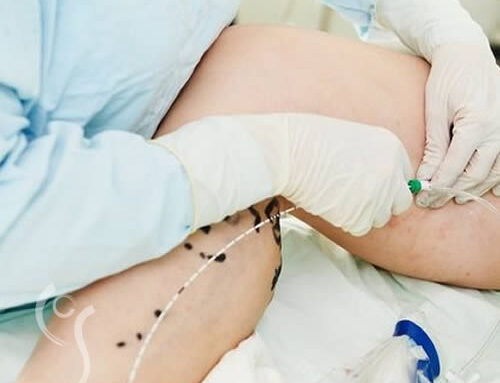 Microcirurgia de Varizes