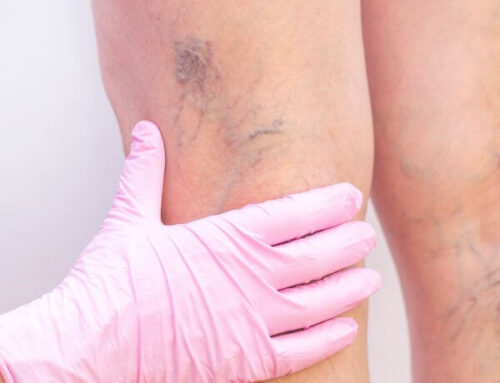 Varizes ou Vasinhos? Entenda a Diferença e a Solução para Cada Caso