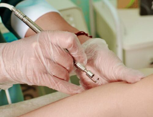 Como Prevenir Varizes: 10 Hábitos Comprovados para Melhorar a Circulação